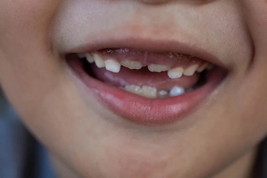 FDA Proposes Ban: Kids' Fluoride Supplements